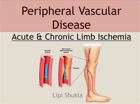 Peripheral artery disease. . Peripheral venous disease causes
